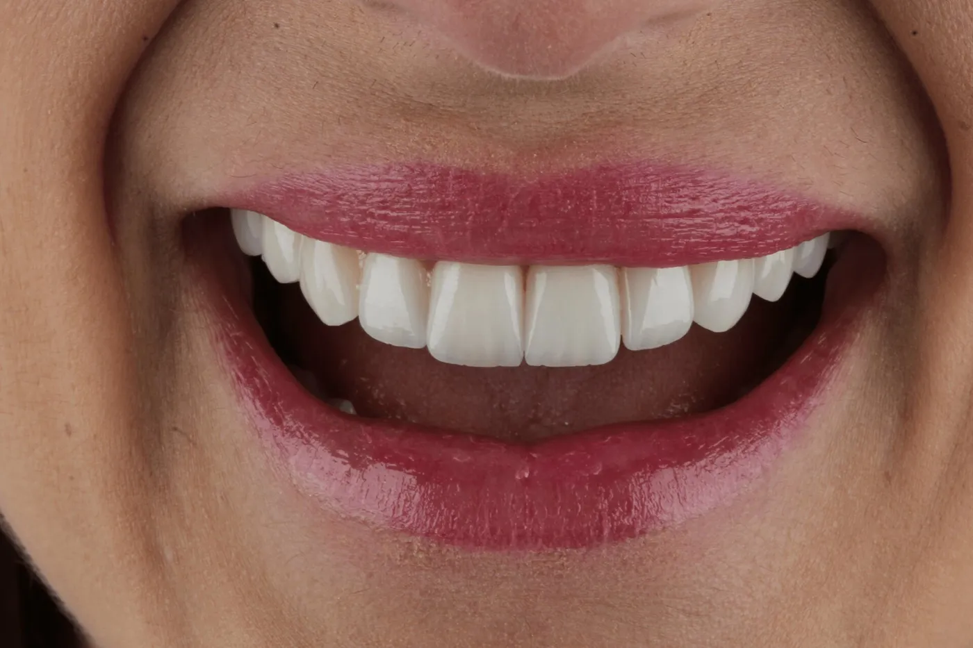 Diseño de sonrisa antes y después en Medellín – Después