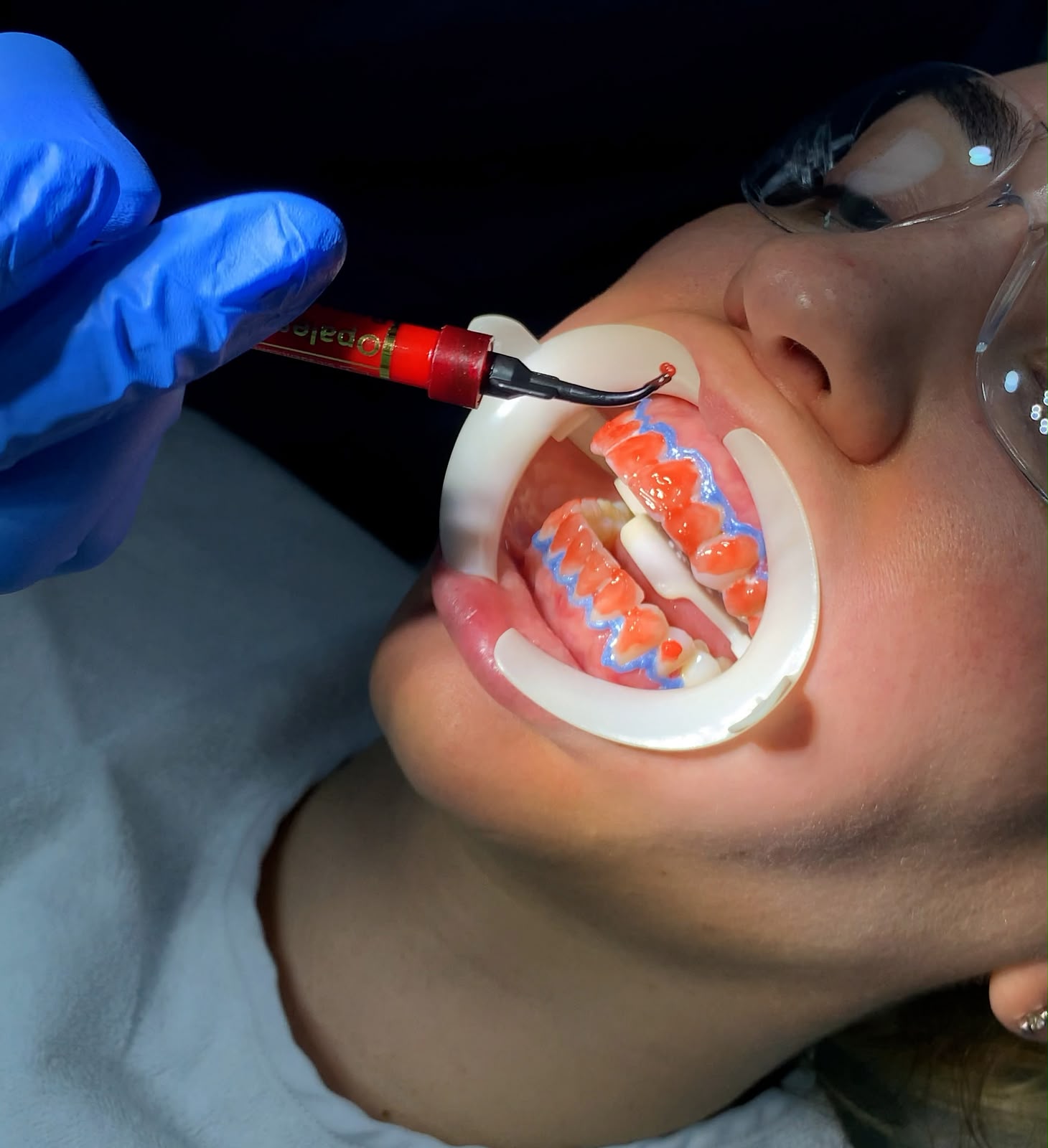 blanqueamiento dental Medellín