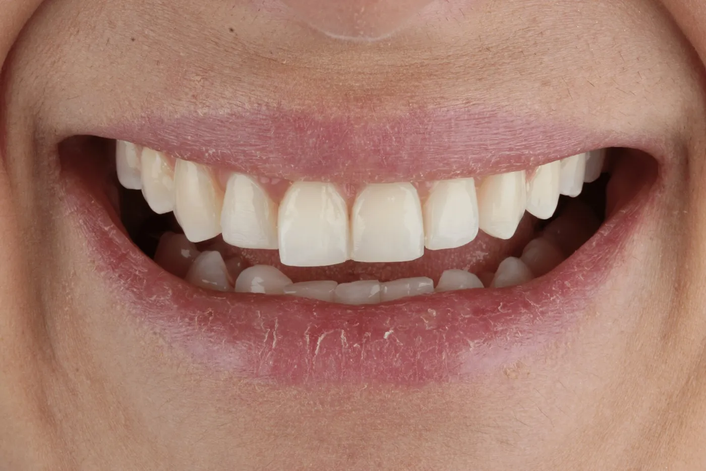 Diseño de sonrisa antes y después en Medellín – Antes